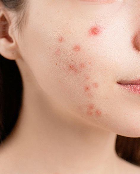 Lactoferrin Anti-inflammatory